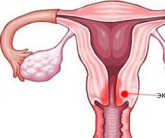 Псевдоэрозия шейки матки: симптомы, причины и лечение